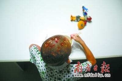 8岁男童遭马蜂蜇300多针 全身血液过滤10遍脱险