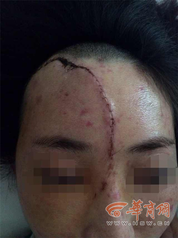 西安女子玩漂流遭毁容面部缝合170针
