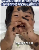 “兽皮痣”患儿乐宝